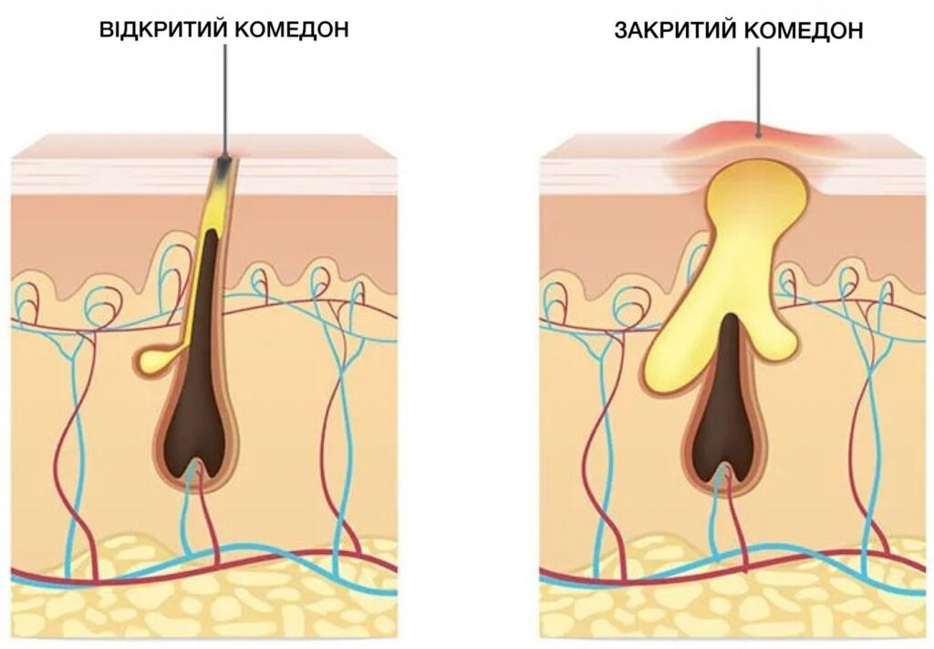 Комедонові прищі - Як вилікувати комедонові прищі?