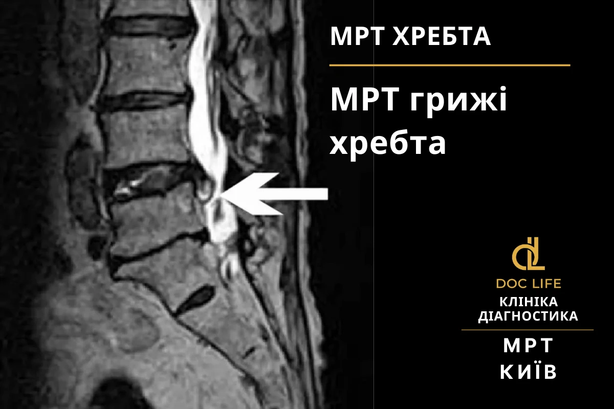 Чим зняти біль при грижі хребта - Наталія Скіжа нейрохірург