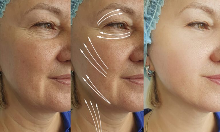 Когда лицо «опускается» не из-за возраста, а из-за напряжения